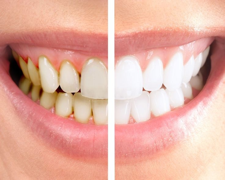 Отбеливайте зубы каждые три или шесть месяцев